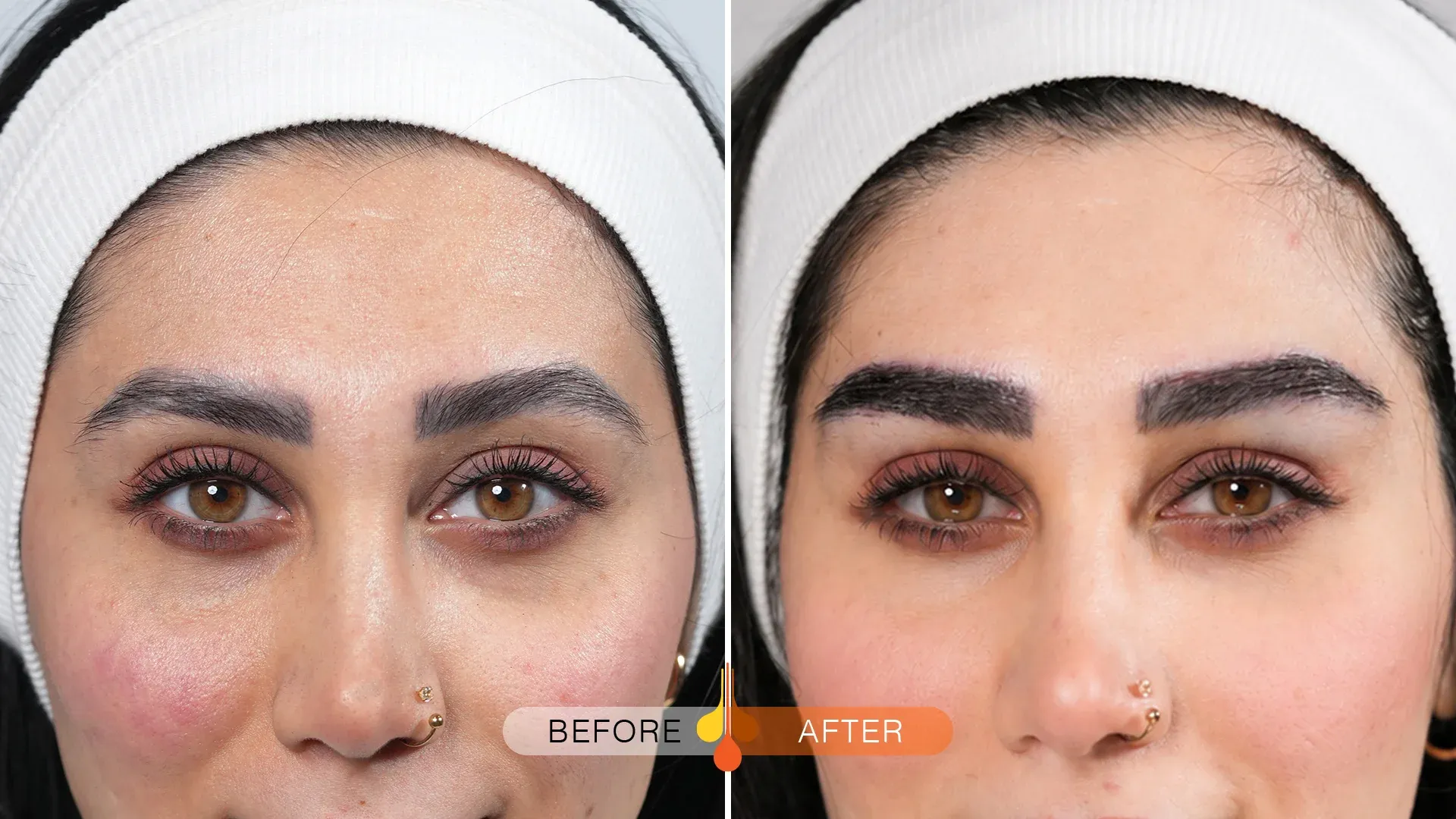 eyebrow-transplant-ksa-02