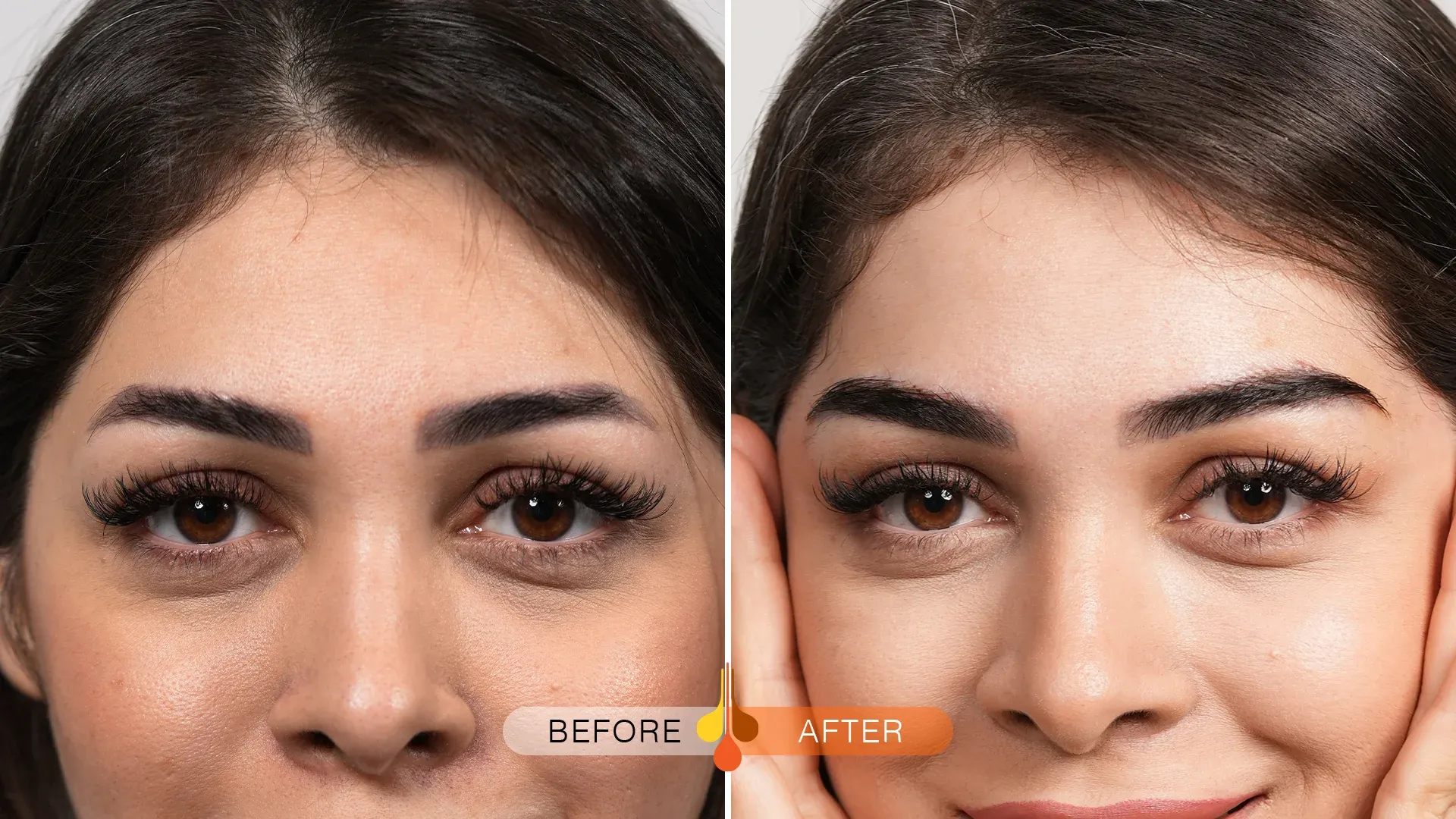 eyebrow-transplant-ksa-03