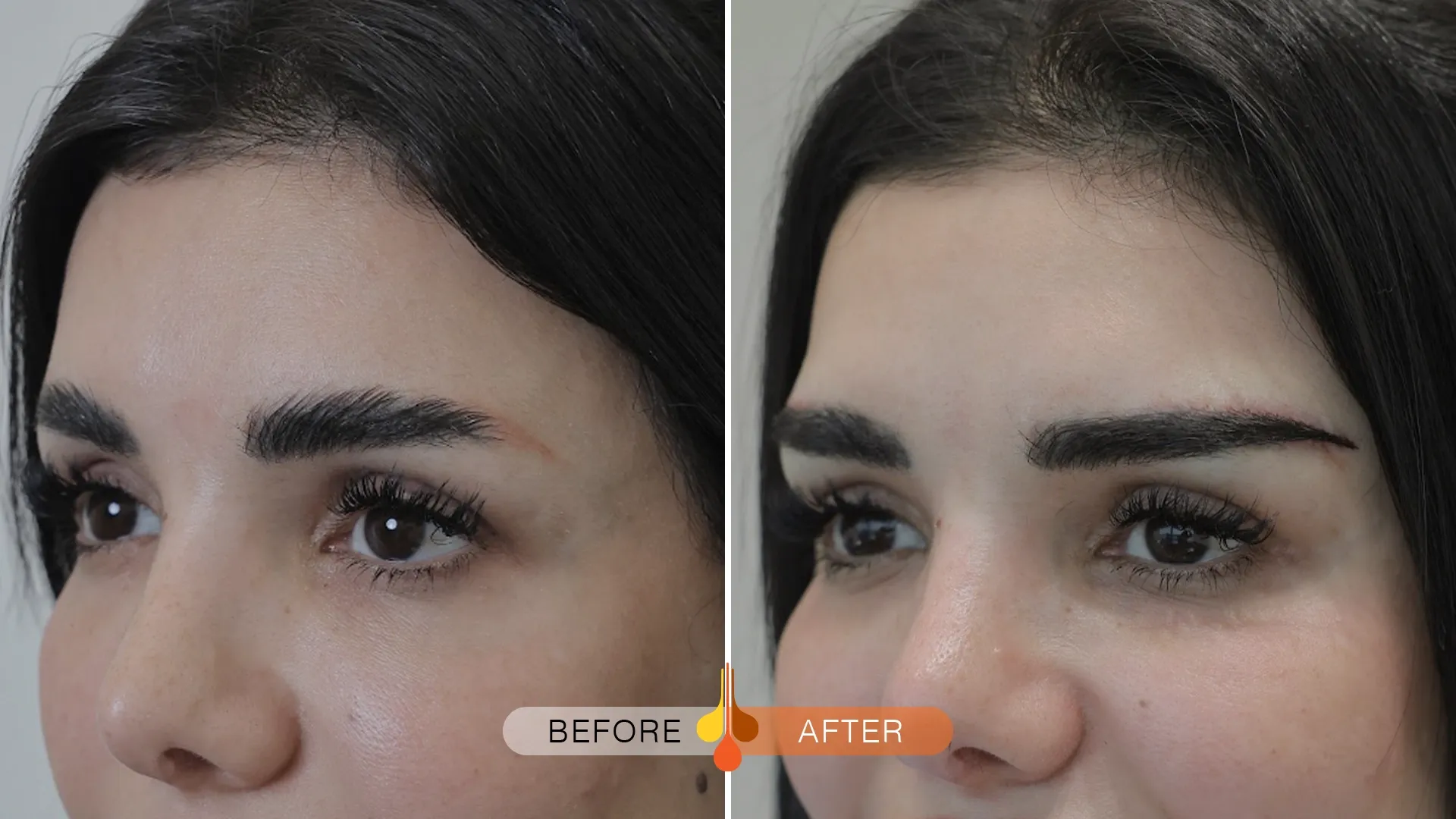 eyebrow-transplant-qatar-01