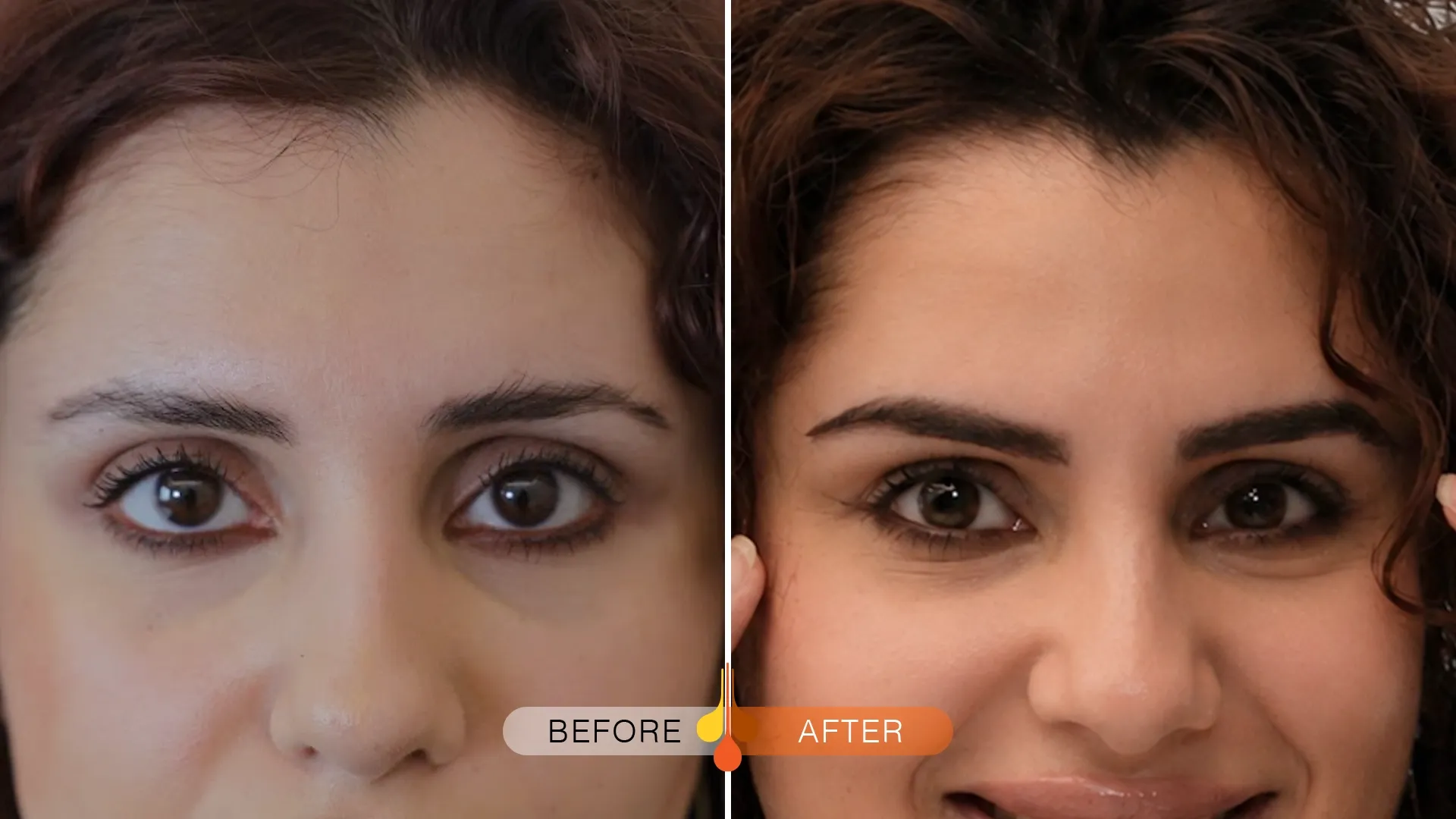 eyebrow-transplant-qatar-02
