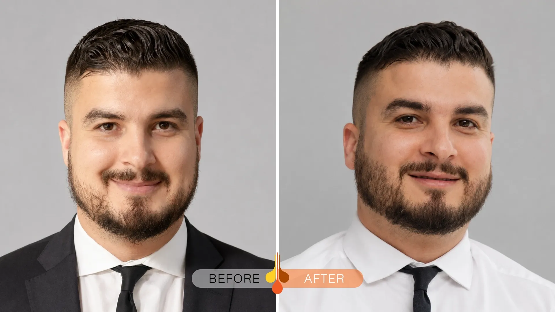 beard-moustache-transplant-06