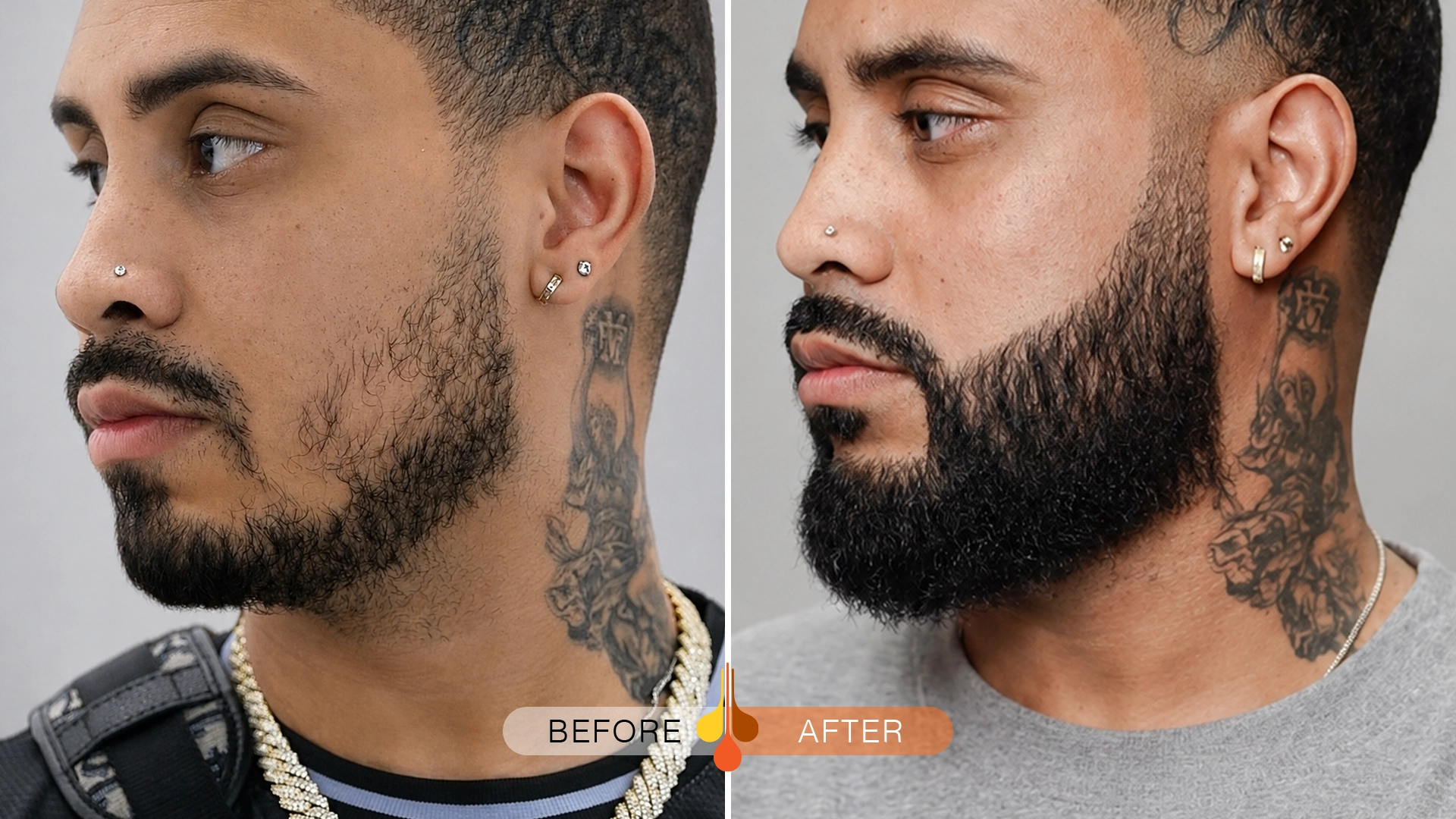 beard-moustache-transplant-ksa-01