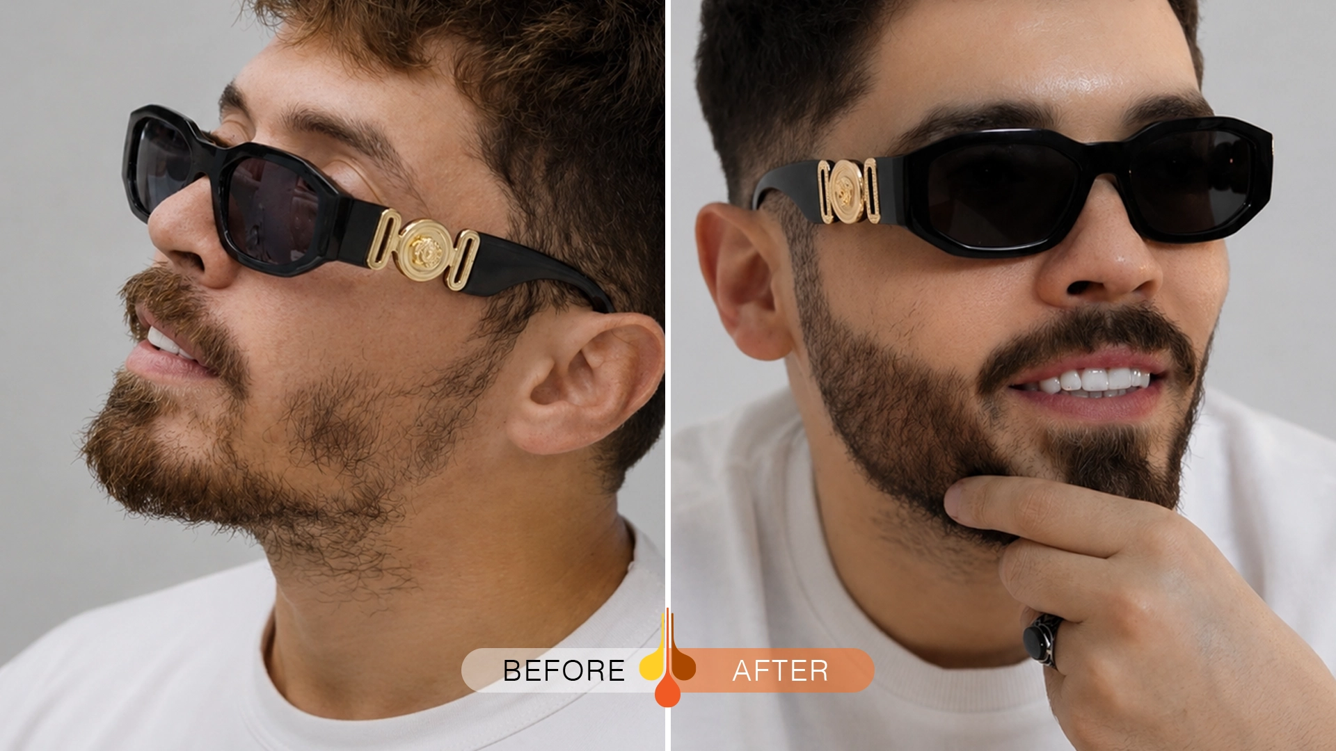beard-moustache-transplant-ksa-02
