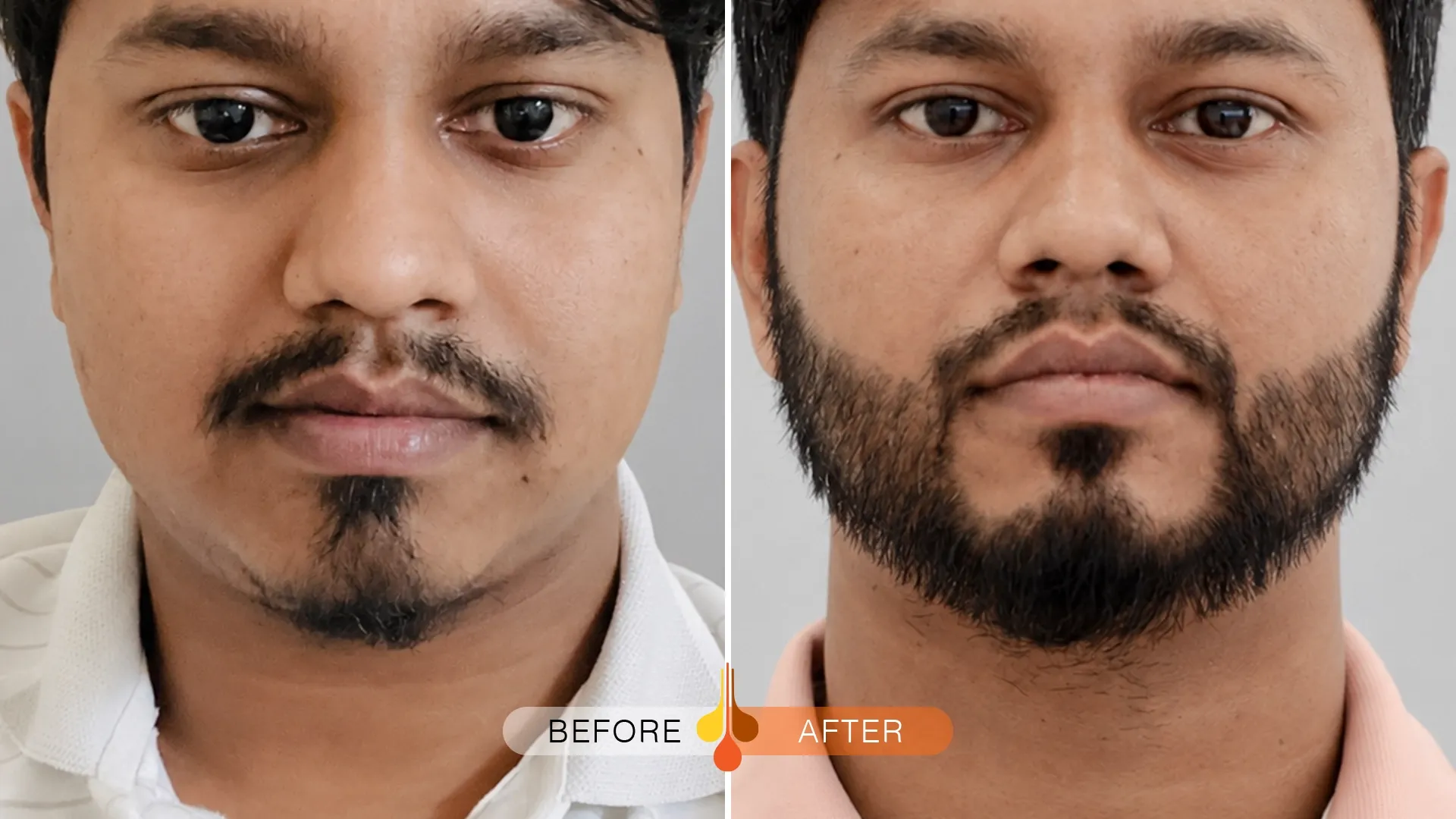 beard-moustache-transplant-qatar-01