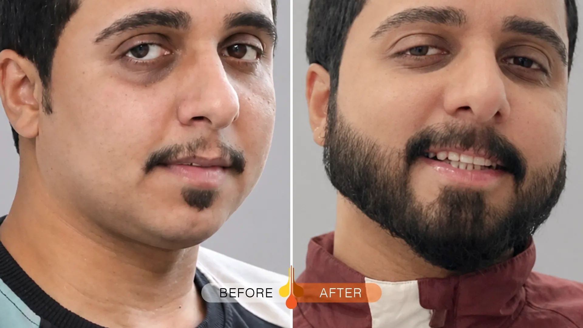 beard-moustache-transplant-qatar-02
