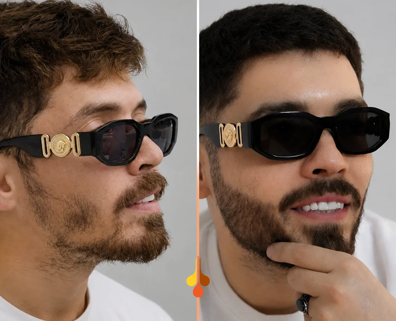 beard-transplant