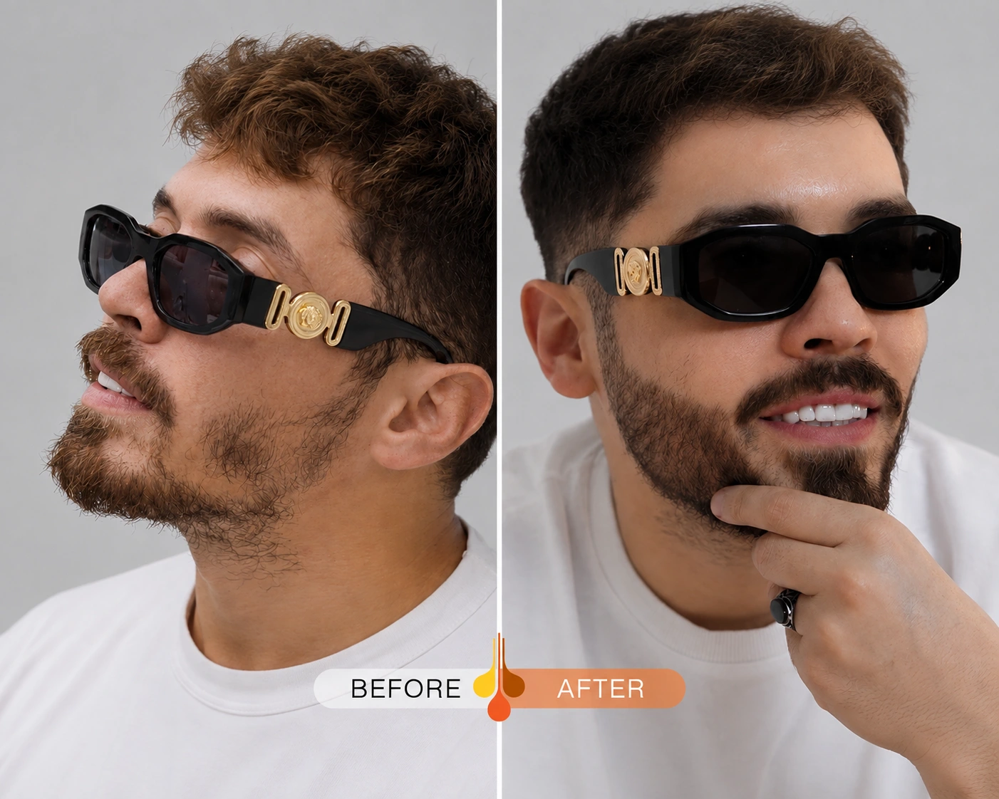 Before and after beard transplant results for a male patient at Padra