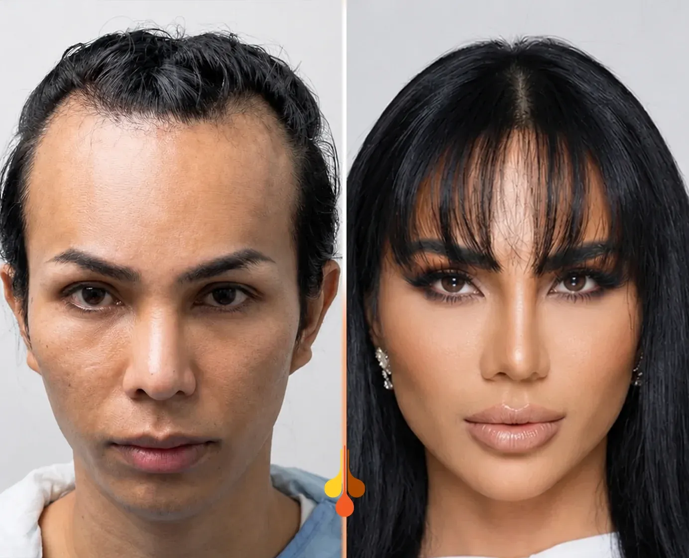 woman-hair-transplant