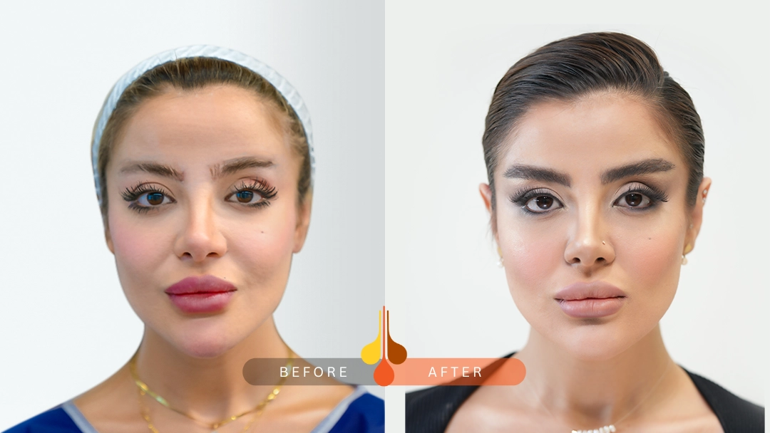 Eyebrow Transplant Results at Padra Clinic 3