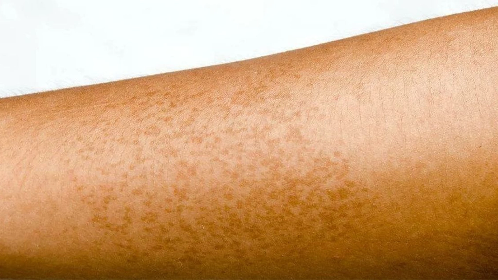  Pigmentation changes after Laser Hair Removal