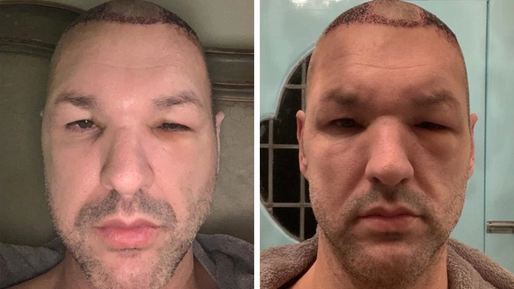 Swelling in the Face, Eyes