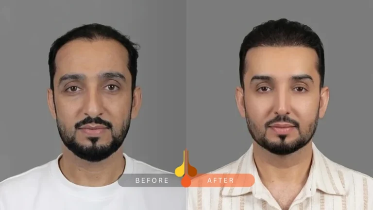 result of hair transplant in qatar