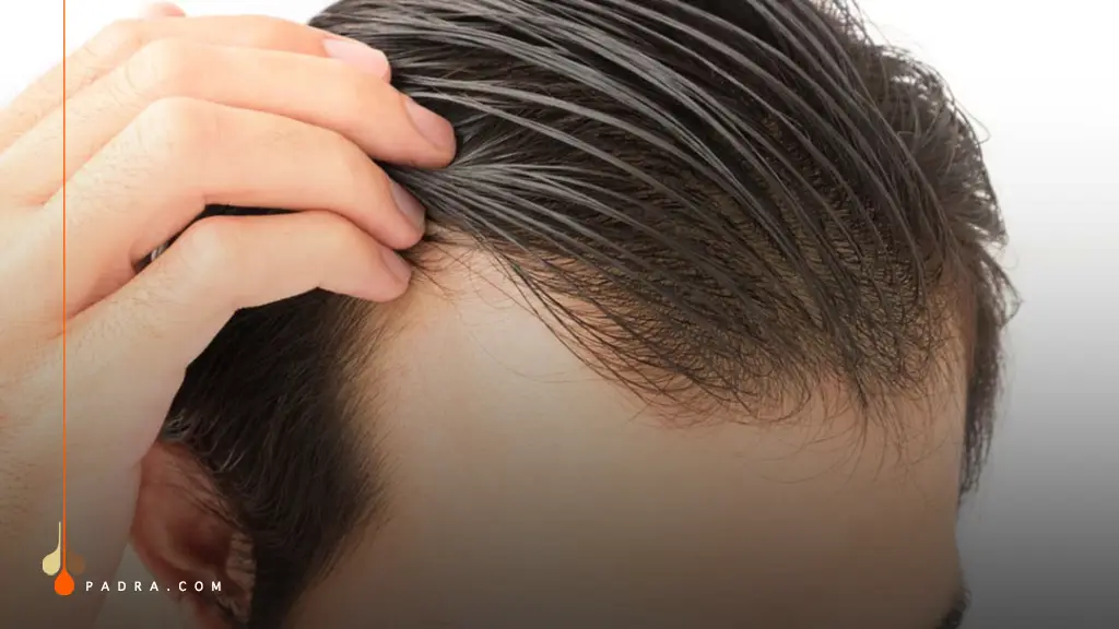 How PRP Works for Hair Loss