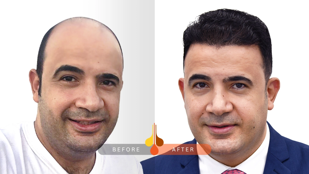 علاج الصلع الوراثي بزراعة الشعر 