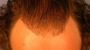unnatural hairline after hair transplant