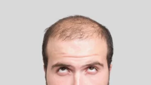 man going bald