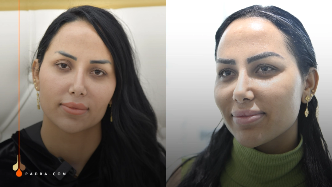 eyebrow transplant before and after