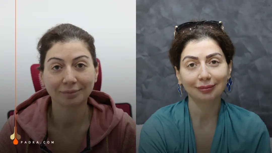Eyebrow transplant in Padra Clinic