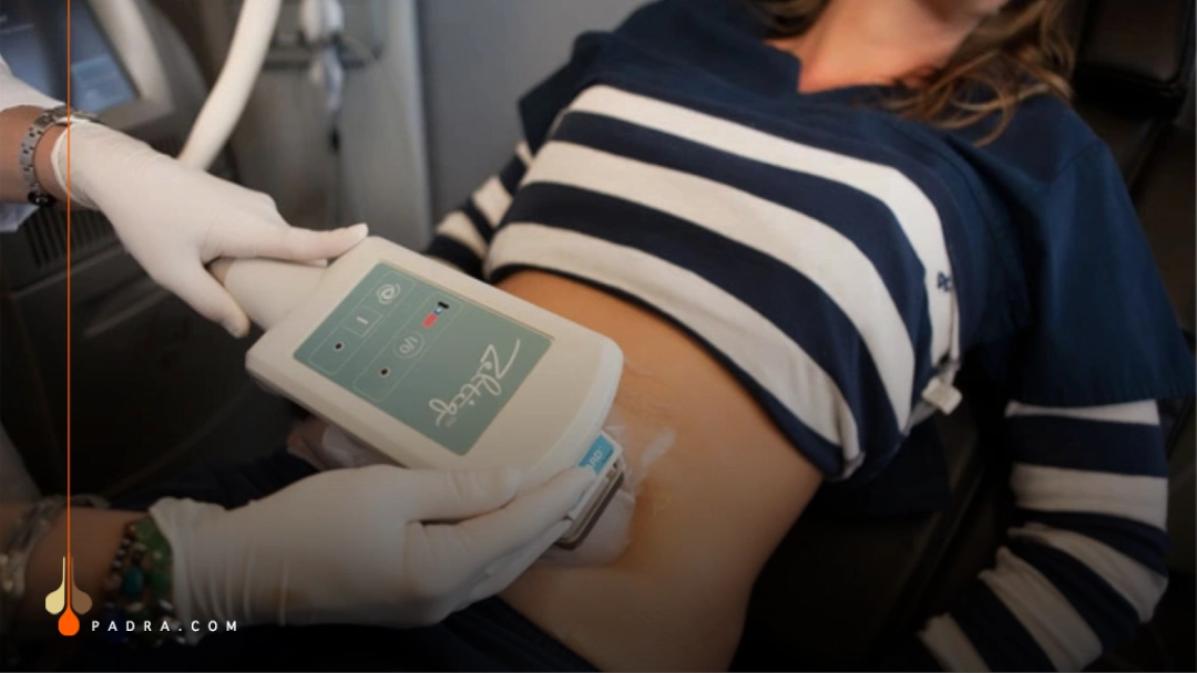 what is fat freezing (cryolipolysis)?