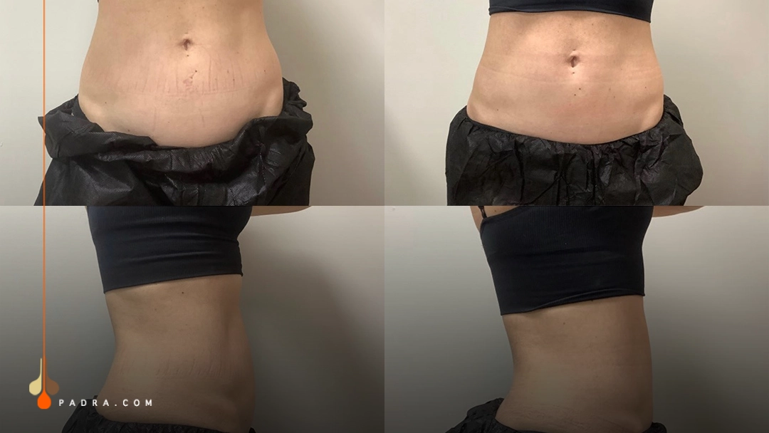 fat freezing before and after