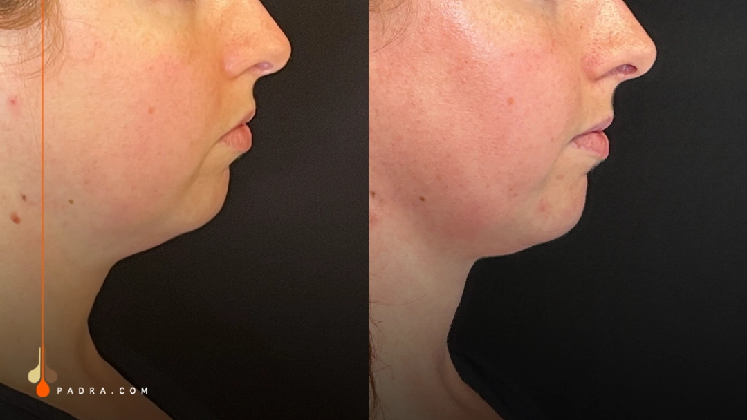 double chin fat freezing before and after