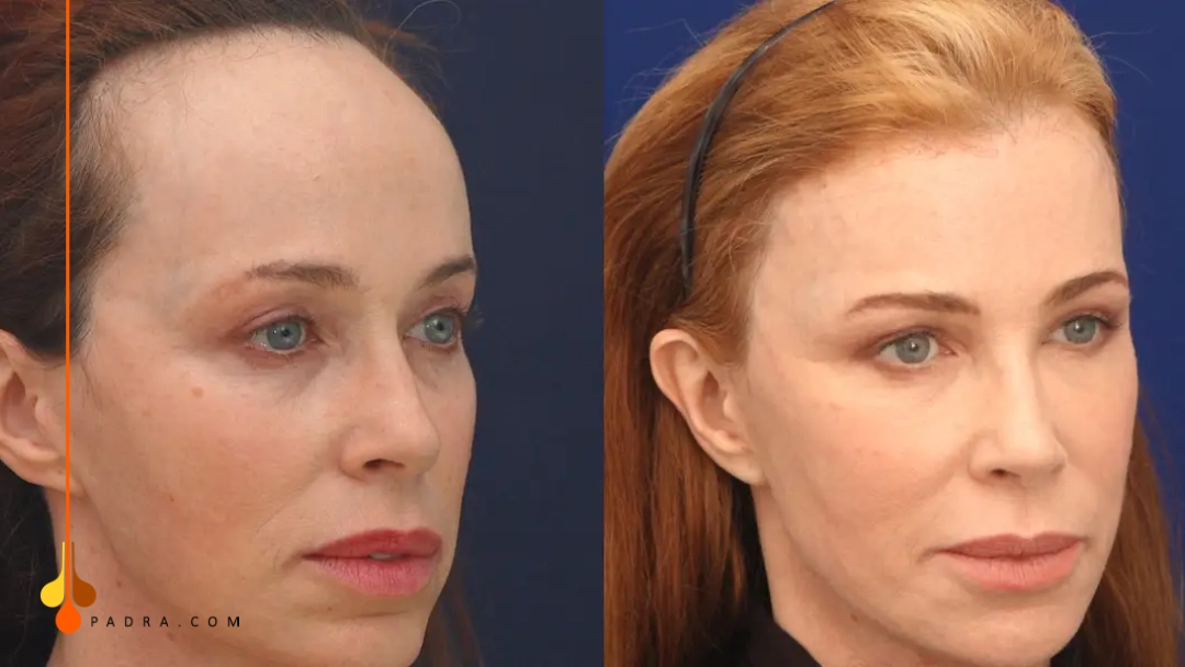 forehead reduction surgery before and after