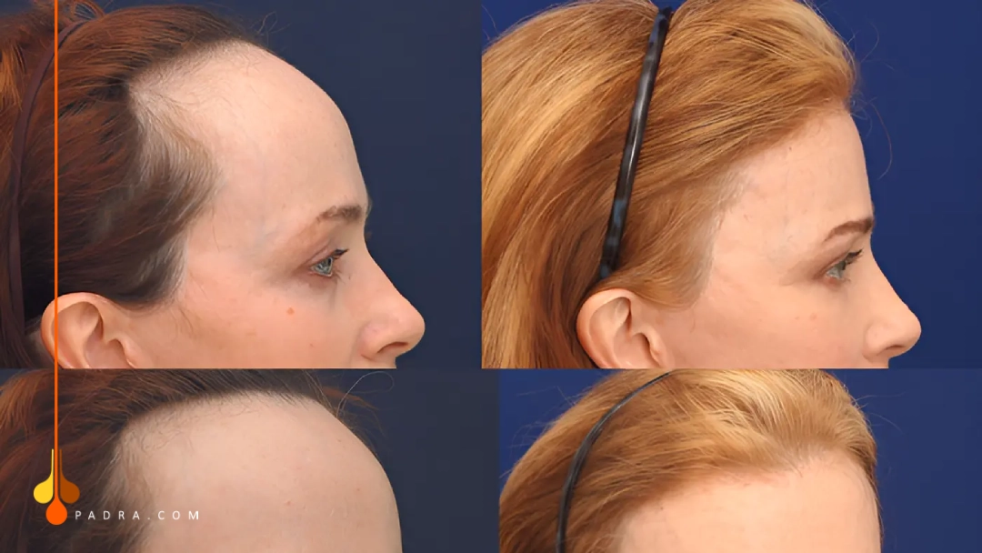forehead reduction post-surgery