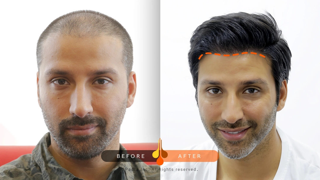 hairline transplant before and after