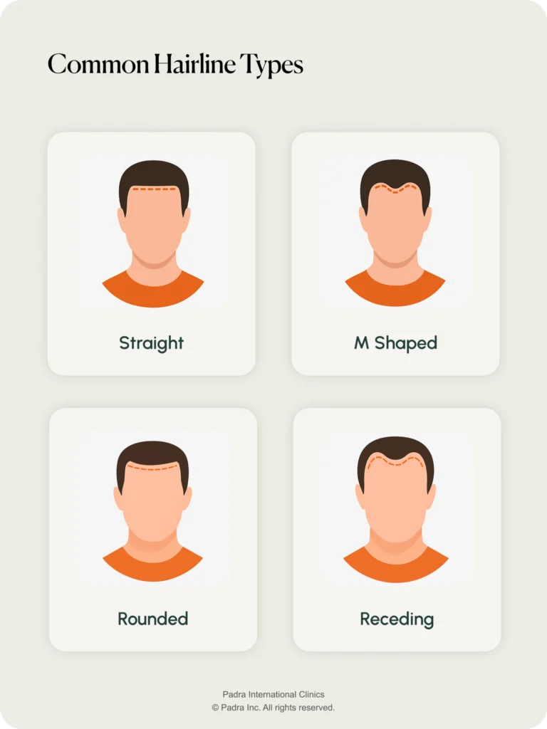 most common hairline types