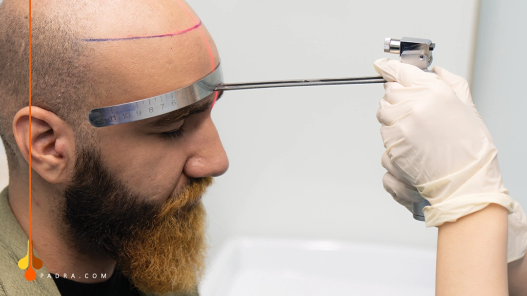 designing hairline for transplant