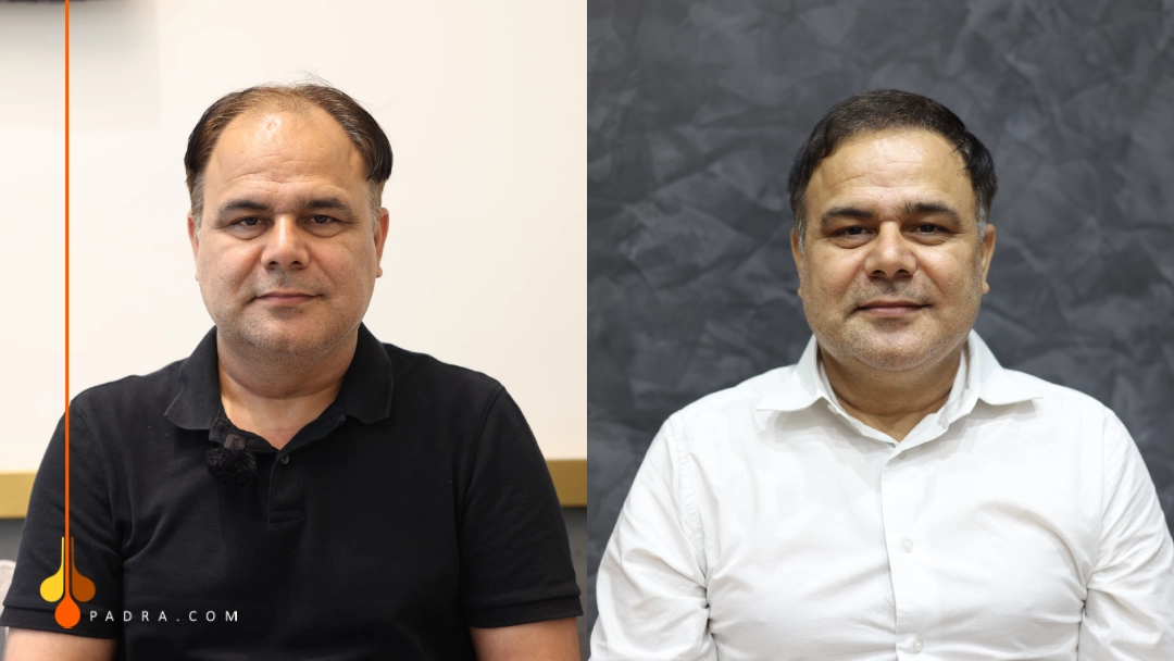 Hair Transplant in Dubai