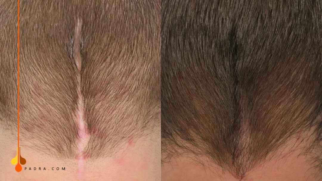 hair transplant on scar tissue before and after