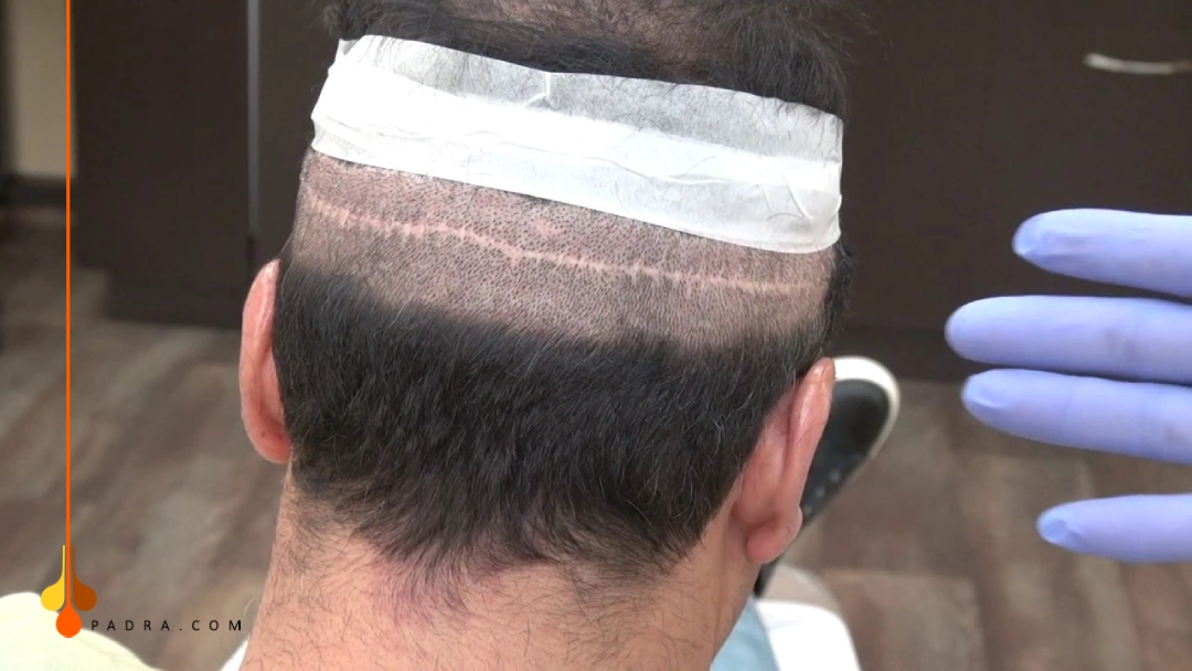 FUT scar