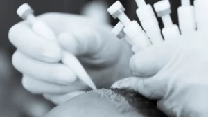 مقارنة بين زراعة الشعر بتقنية السفیر و تقنية DHI