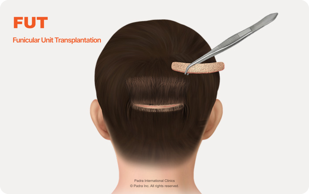 FUT Hair Transplant