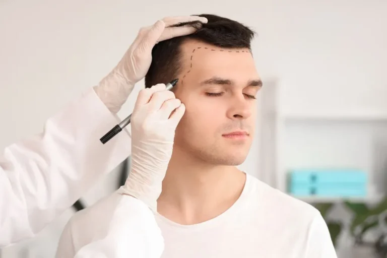 Go to Turkey for Hair Transplants