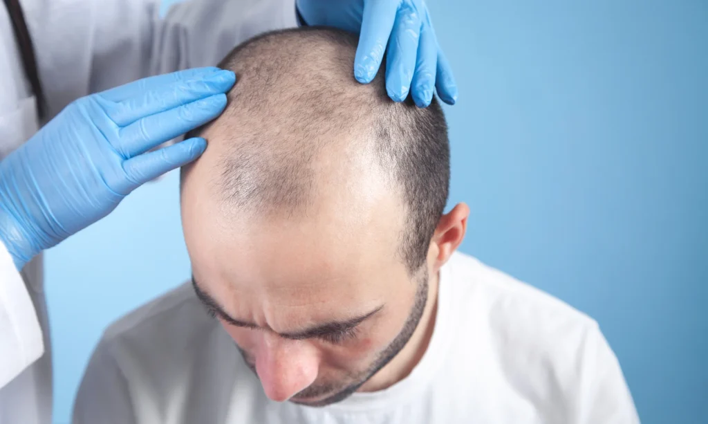 Hair Falling Out After Transplant