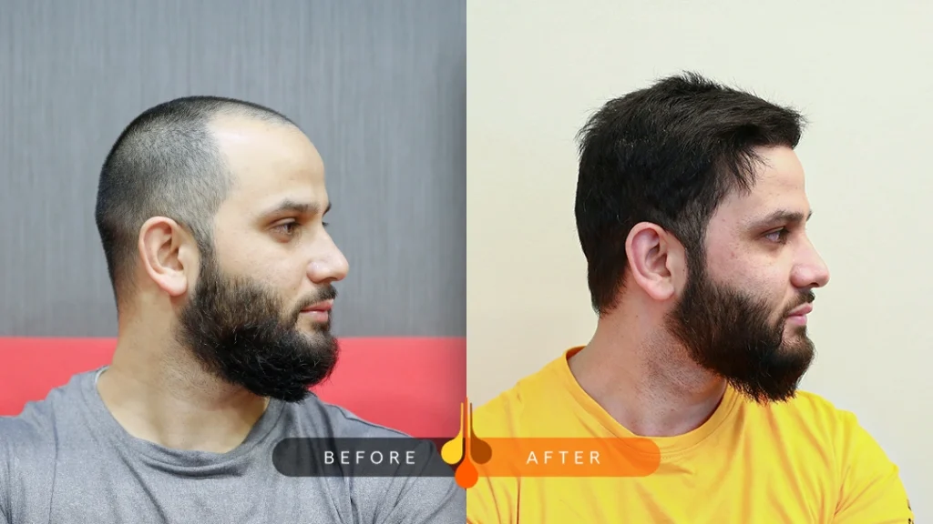 الى متى تبقى نتيج زراعة الشعر 