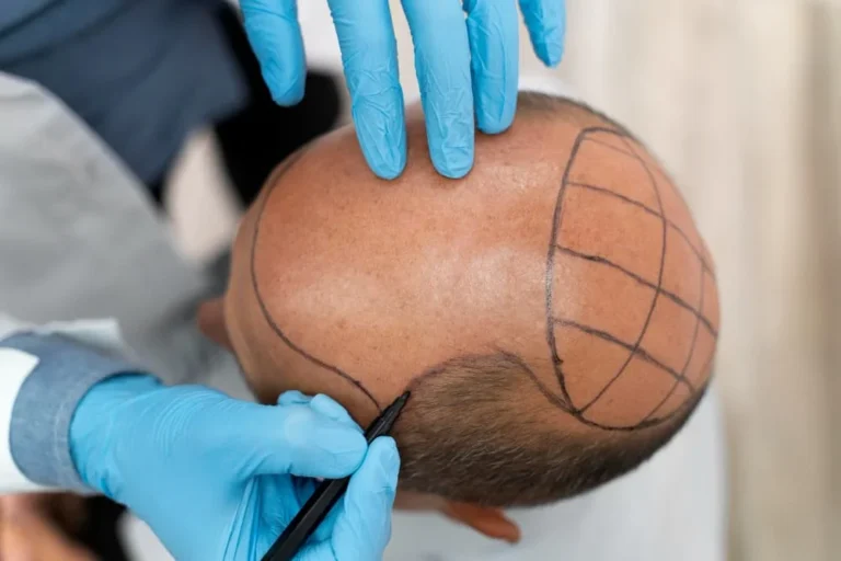 Hair Transplant With Donor Hair
