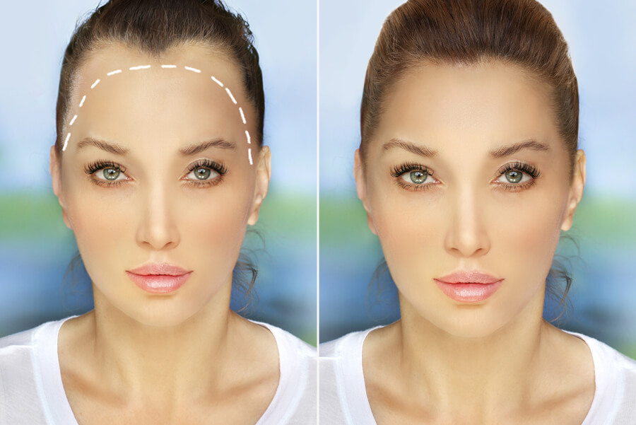 Hair transplant success rate for women
