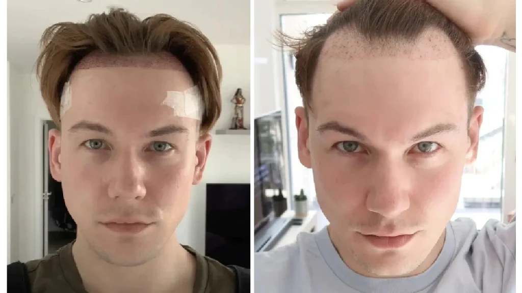 من الإسبوع الثاني الي الرابع بعد زراعة الشعر 