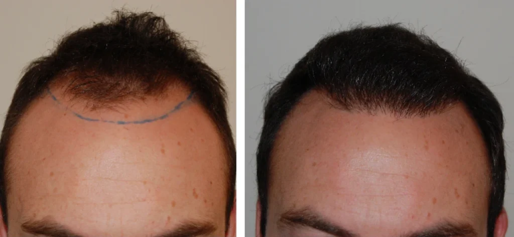 من شهر الرابع الي الشهر السادس لزراعة الشعر 