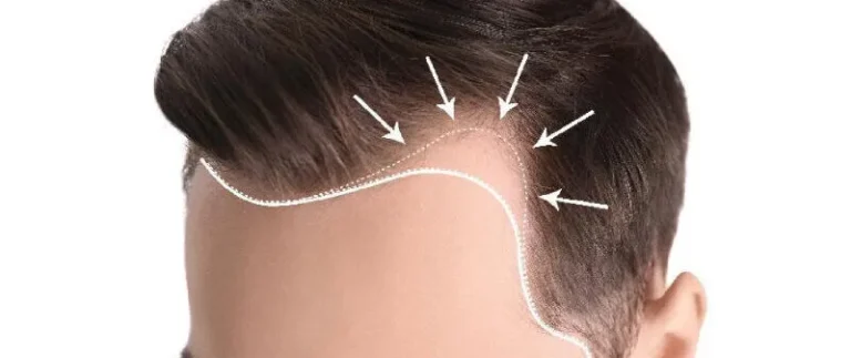 Hairline Surgery for Men