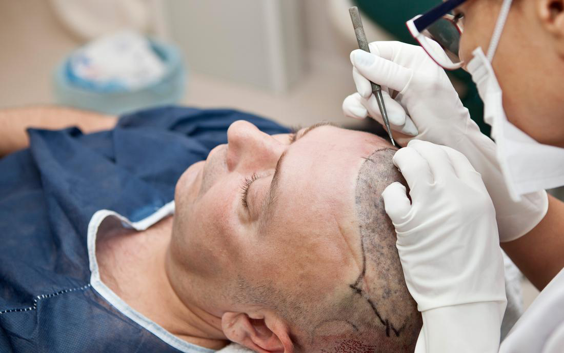 كم تستغرق عملية زراعة الشعر