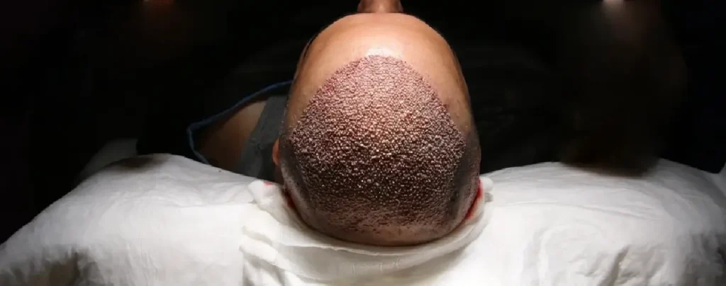 وضع الرأس مباشرة علي الوسادة بعد زراعة الشعر، يعتبر من الأخطاء