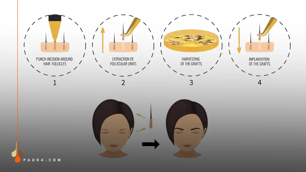 eyebrow transplant step by step