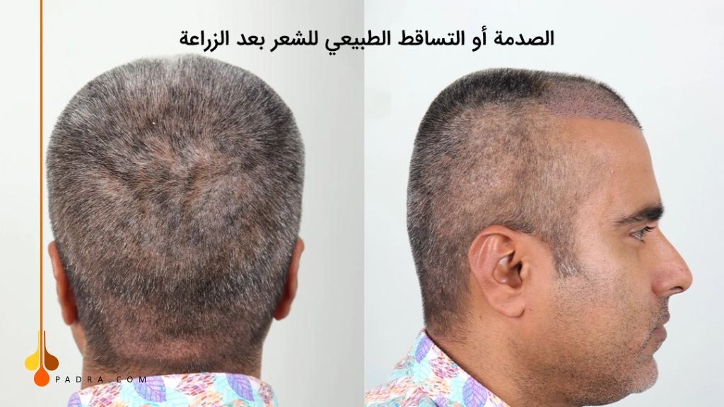 فرق التساقط الطبيعي للشعر بعد الزراعة و الصدمة 