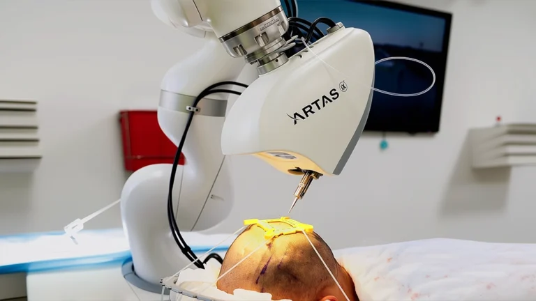 زراعة الشعر بالروبوت
