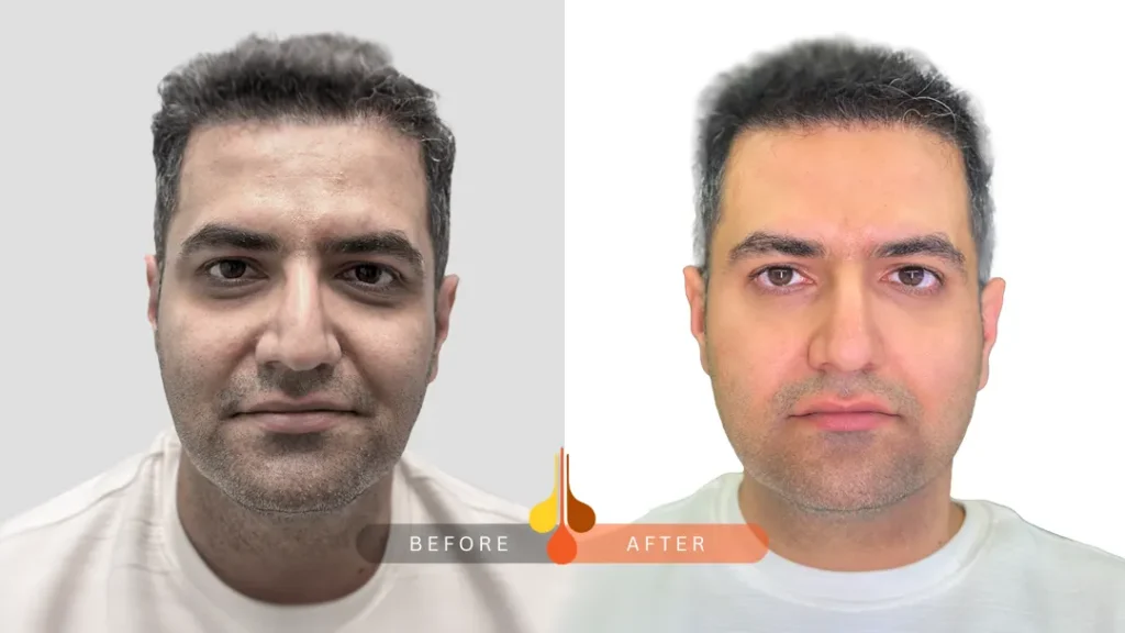 صور قبل و بعد فیلر للهالات السوداء