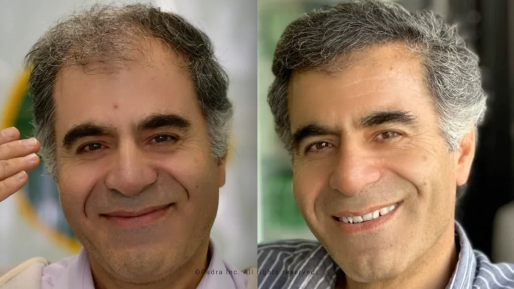 temple hair transplant